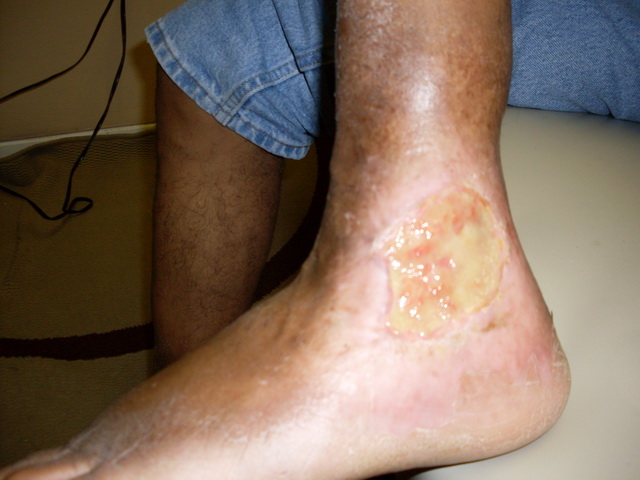 Gangrene Infection After Treatment