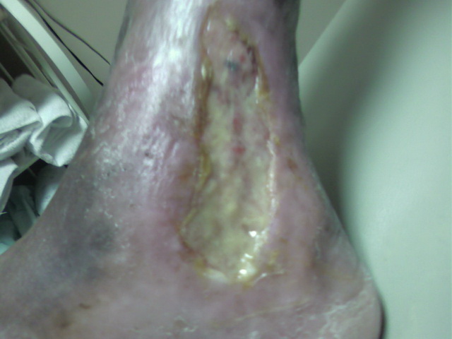 Gangrene Infection Before Treatment